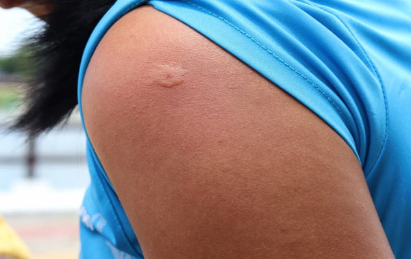 hornet_sting_person_man_shoulder