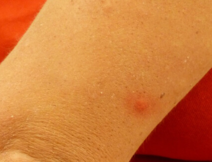 A spider bite on a forearm