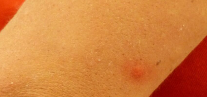 A spider bite on a forearm