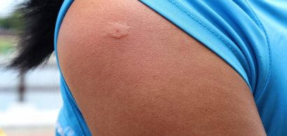 hornet_sting_person_man_shoulder